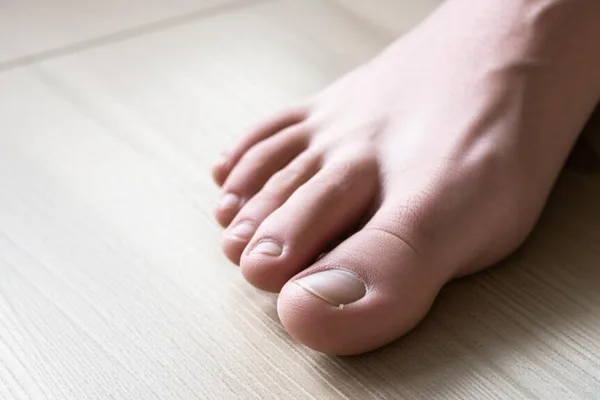 හැමර්ටෝ (Hammertoe) එන එක වළක්වා ගන්නේ කොහොමද? අපි මේ ගැන කතා කරමු!