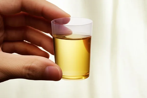 ඔයාගේ මුත්රා පරීක්ෂණ වාර්තාව (Urinalysis) කියන්නේ මොකක්ද? අපි මේ ගැන සරලව කතා කරමු