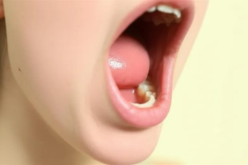ඔයාගෙත් උගුරේ ටොන්සිල් (Tonsils) නිතරම ප්රශ්න දෙනවද? අපි මේ ගැන හරියටම දැනගමු!