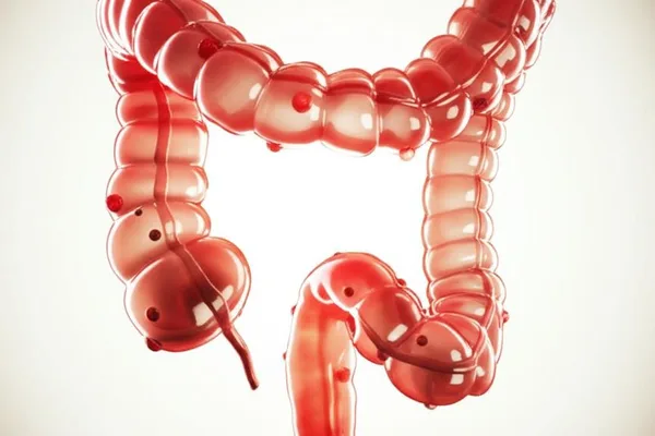 ඔයාගේ මහා බඩවැලේ පොඩි ගෙඩි (Colon Polyps) ගැන දැනගමුද? බය වෙන්න එපා, අපි කතා කරමු!