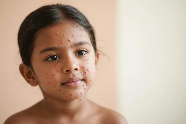 ඔයාගේ පොඩ්ඩට පැපොල හැදුනොත්? (Chickenpox/Varicella) බය වෙන්න එපා, අපි මේ ගැන කතා කරමු!