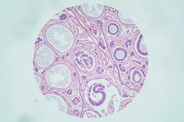 ඔයාගේ වකුගඩුවේත් මේ වගේ ගෙඩියක්ද? (Renal Angiomyolipoma) – බය වෙන්න එපා, අපි මේ ගැන විස්තර කතා කරමු!