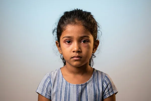 ඔයාගේ පොඩිත්තාගේ ඇහැ වටේ ඉදිමිලාද? මේ භයානක තත්ත්වය (Orbital Cellulitis) ගැන දැනගමු!