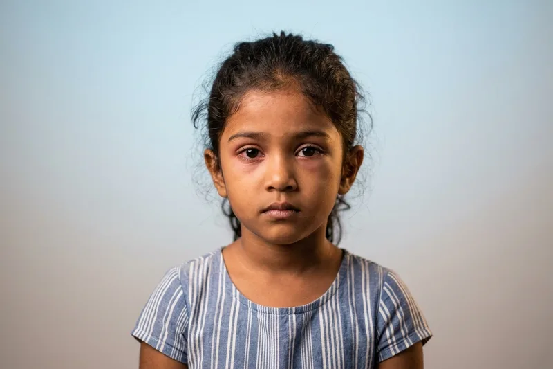 ඔයාගේ පොඩිත්තාගේ ඇහැ වටේ ඉදිමිලාද? මේ භයානක තත්ත්වය (Orbital Cellulitis) ගැන දැනගමු!